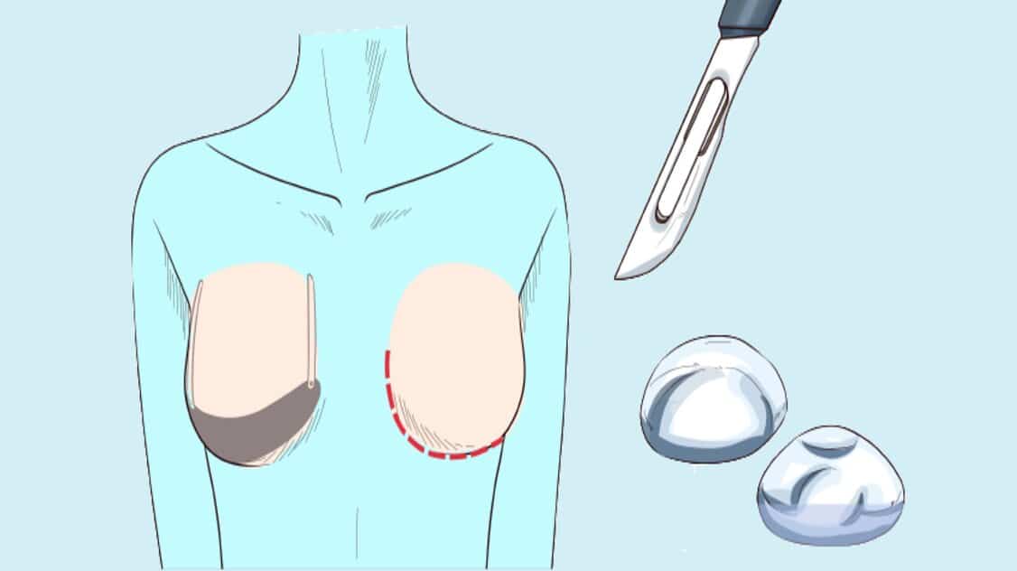 تصحيح عمليات تكبير الثدي (تايلاند)